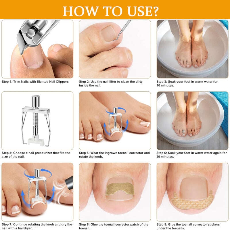 Professional Ingrown Nail Corrector Set